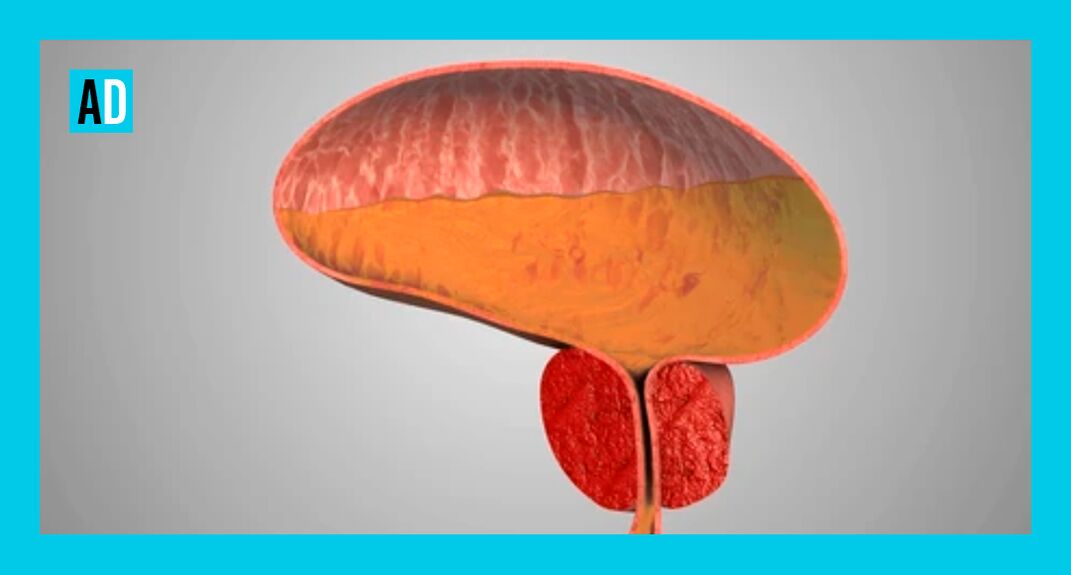 Glande de la prostate enflammée